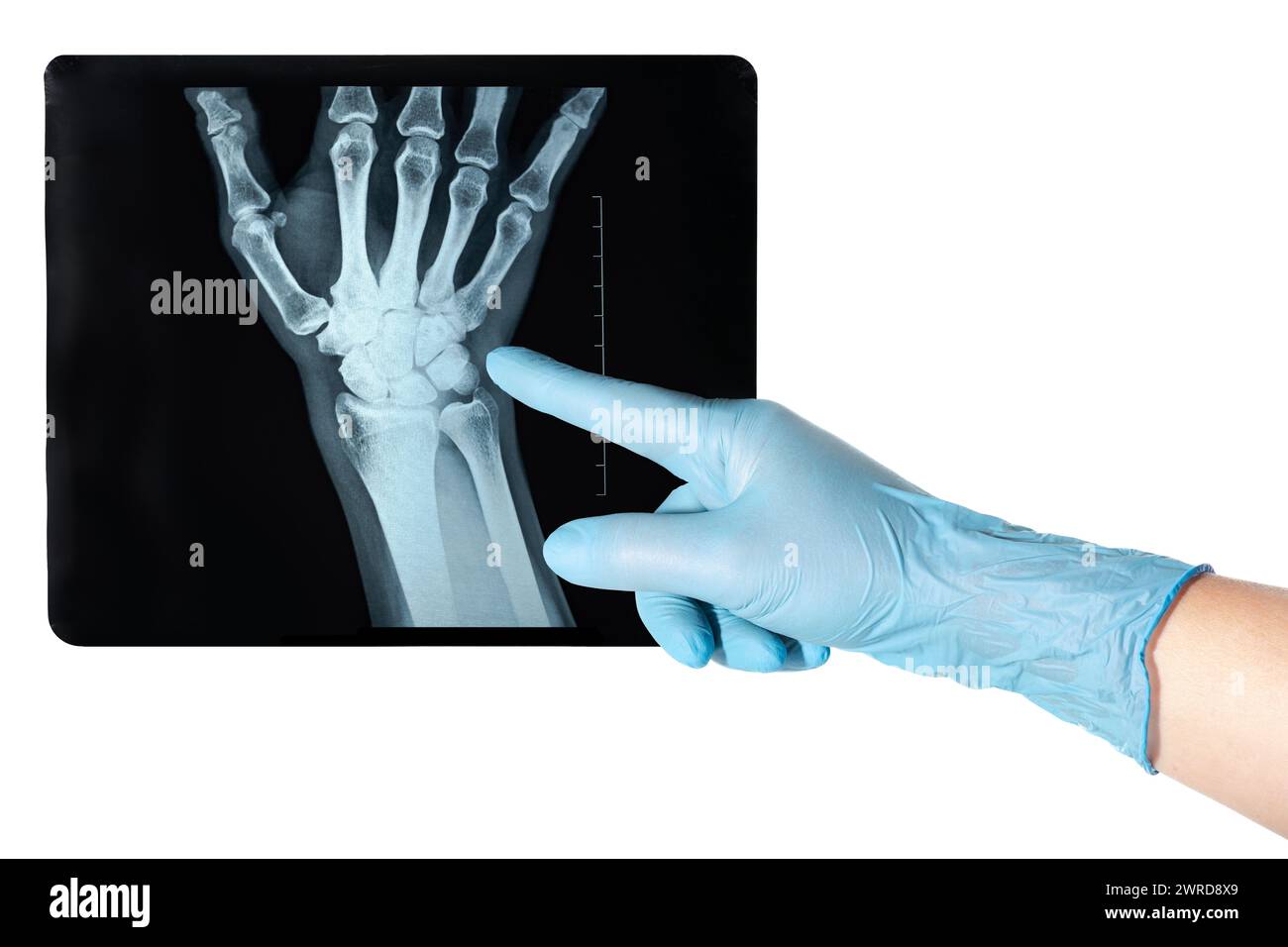 Hand in medical blue glove points X-ray of the side of a woman`s hand uncommon traumatic wrist injury trauma result Stock Photo